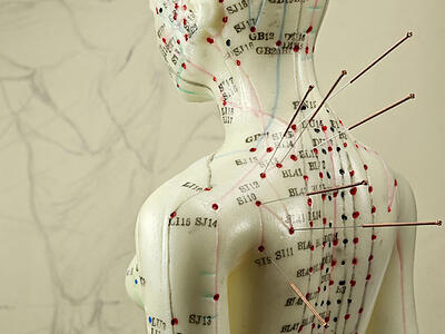 7 Acupuncture Side Effects That You Should Know About