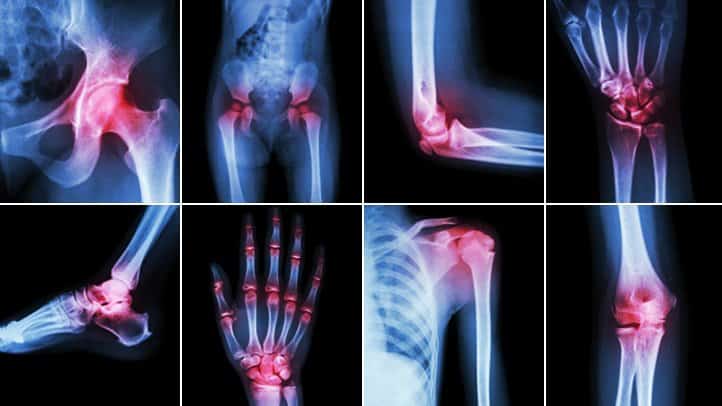 Acupuncture for the Relief of Arthritis Pain