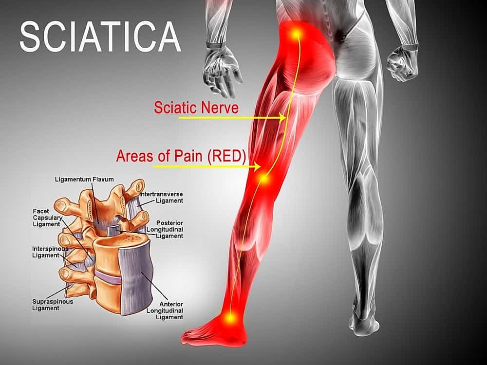 Treating Sciatica with Acupuncture