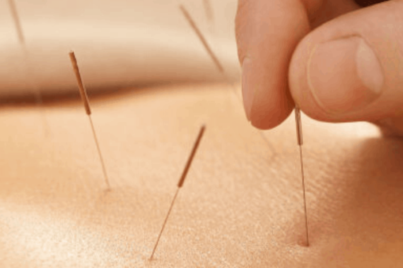 back acupuncture