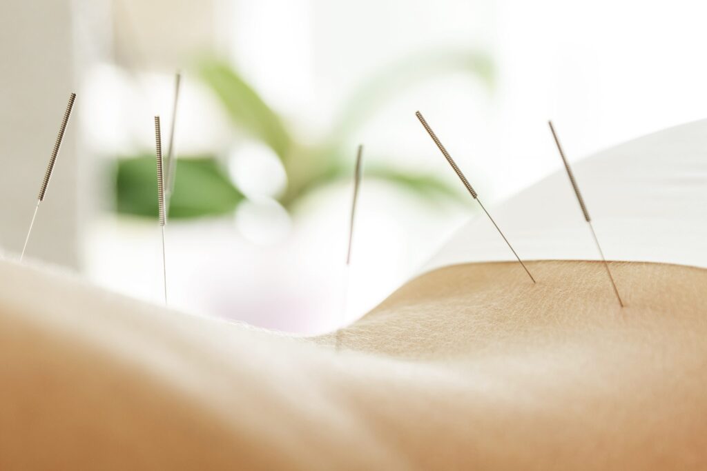 acupuncture needles