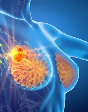 breast-cancer-complication-service Breast Cancer