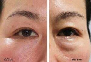 eye rejuvenation eye bags removing case 1