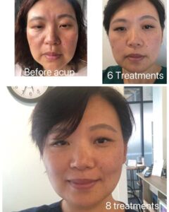 face acupuncture case