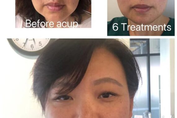face acupuncture case