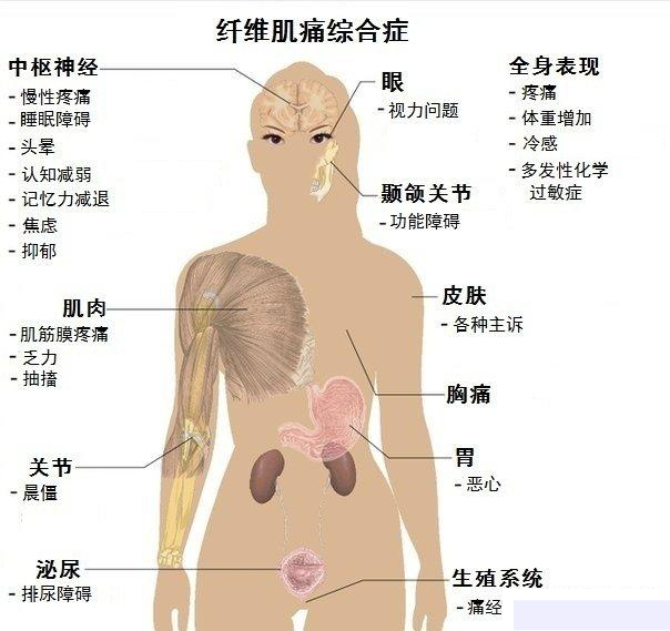纤维肌痛 纤维肌痛综合症