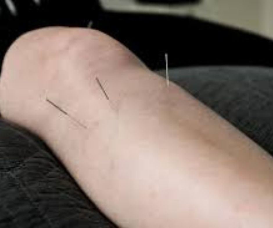 Acupuncture acupuncture treatment for pain relief