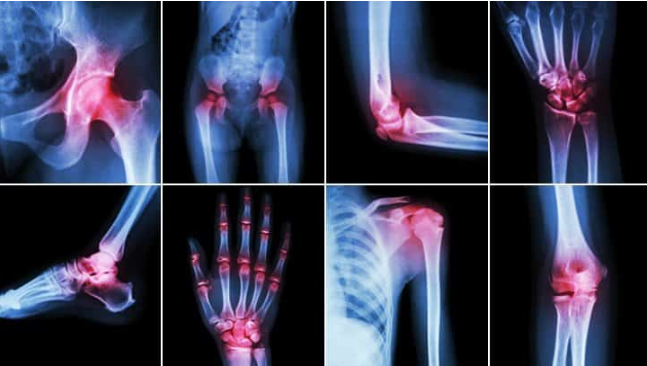 Arthritis arthritis