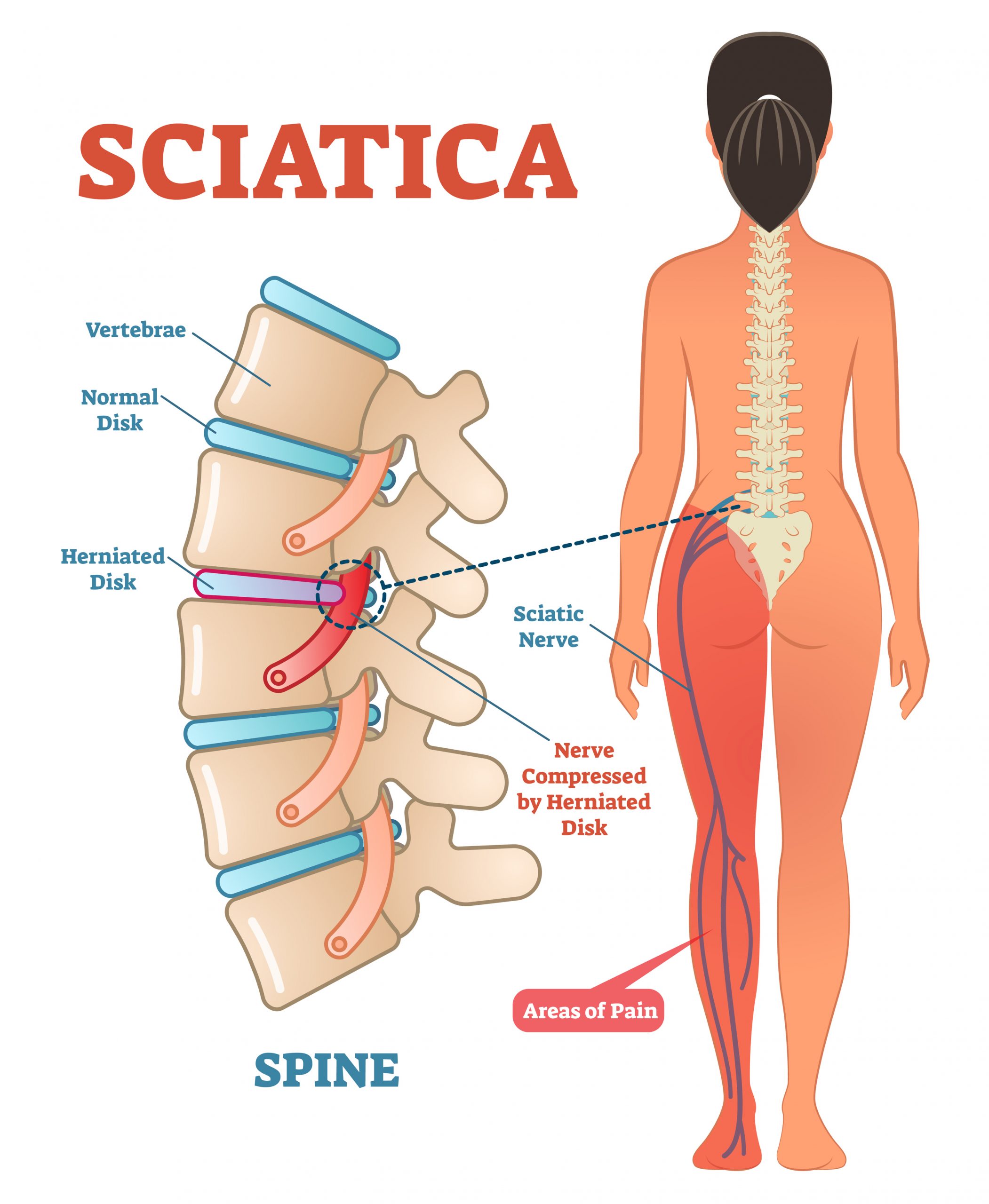sciatica pain treatment