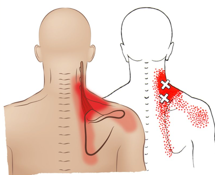 neck and shoulder pain acupuncture for shoulder and neck pain