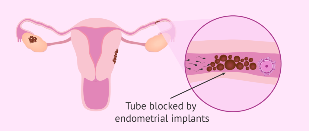 endometriosis