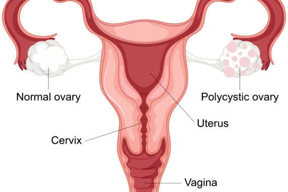 polycystic ovarian syndrome