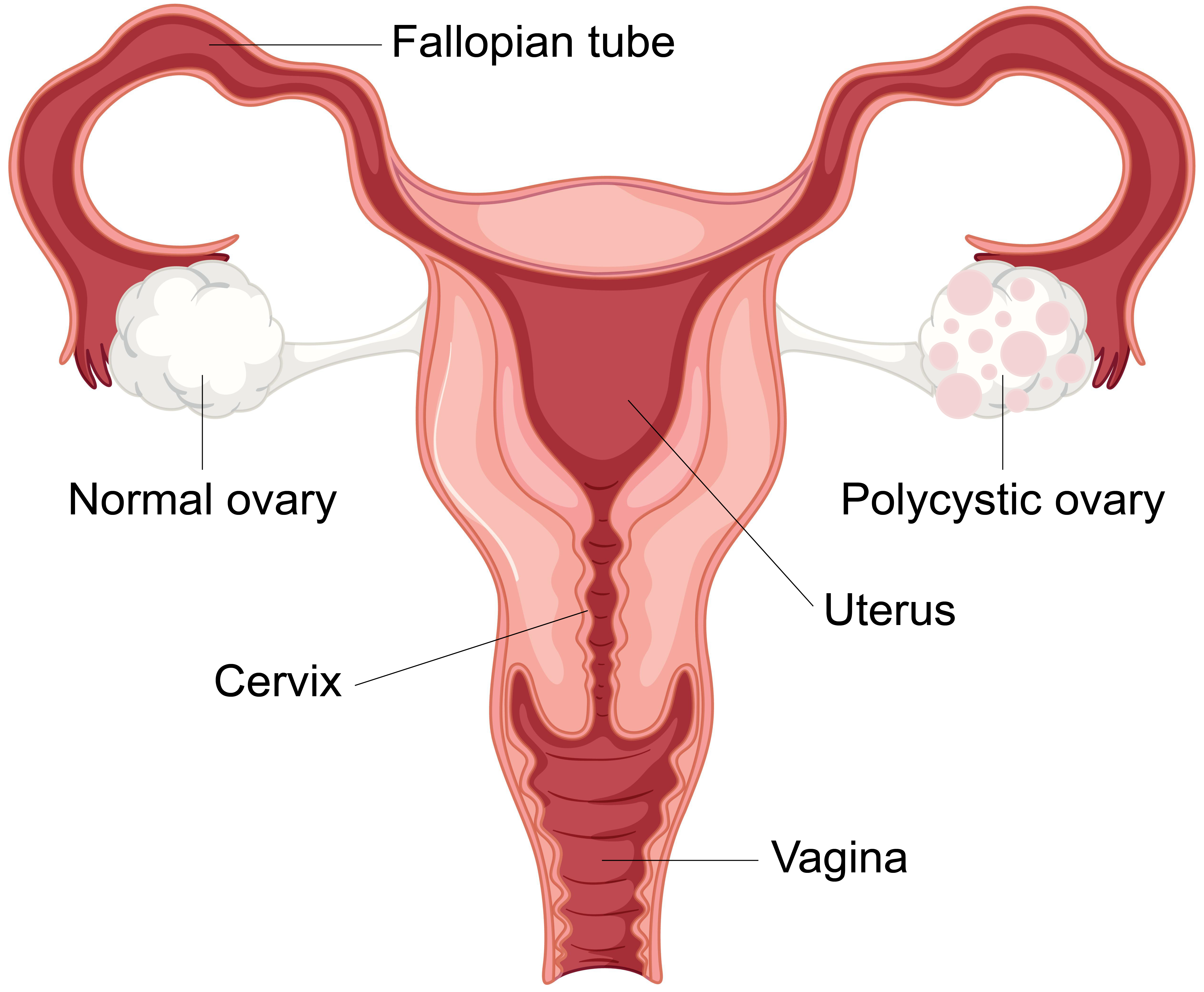 polycystic ovarian syndrome