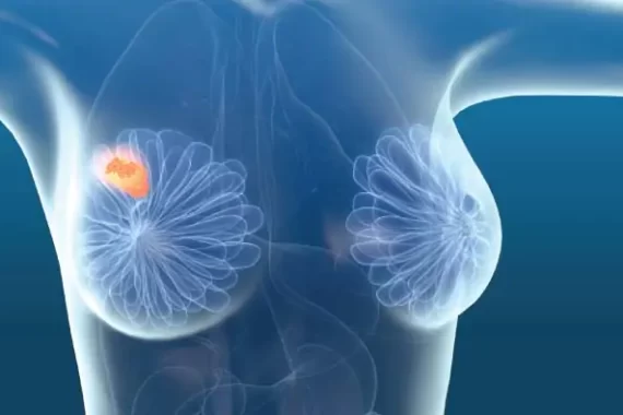 breast lumps