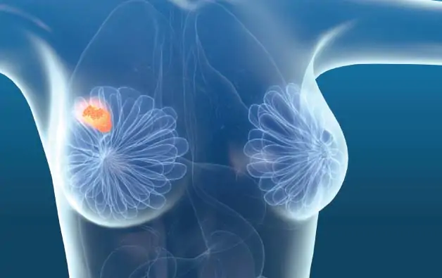 breast lumps
