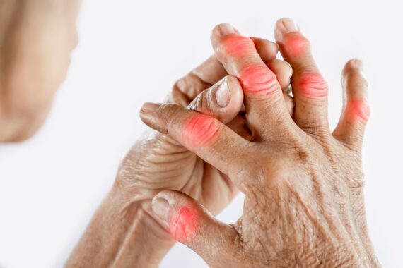 arthritis
