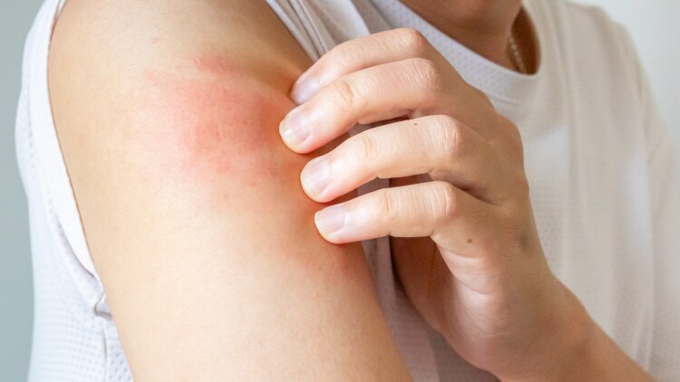 202505-buyingguide-eczema-750x422 eczema treatment auckland