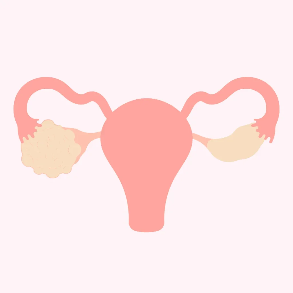 PCOS treatment